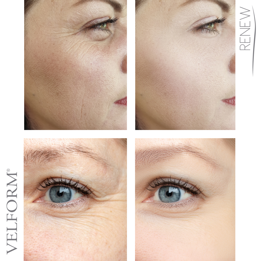 Renew Collagen Hyaluronic Patch